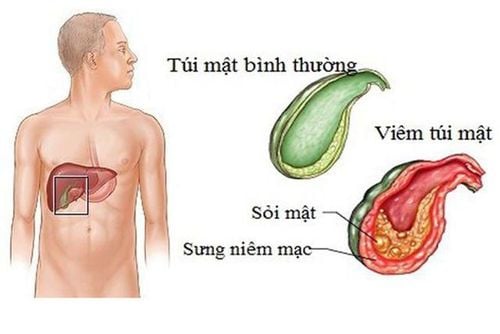 Viêm túi mật cấp