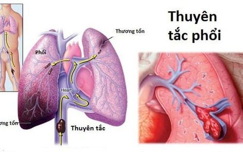 Thuyên tắc phổi sau sinh
