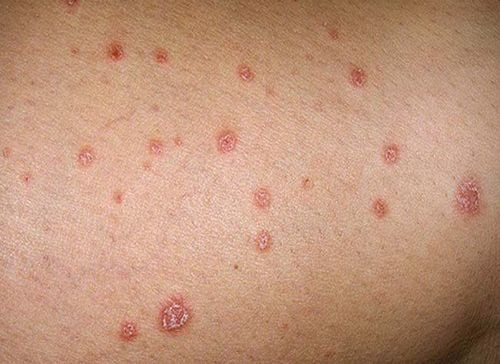 Tổn thương vảy nến thể giọt trên thân mình