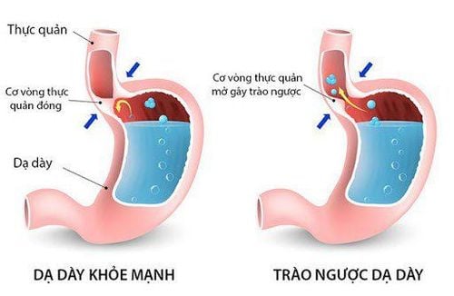 Trào ngược dạ dày và co thắt thanh quản