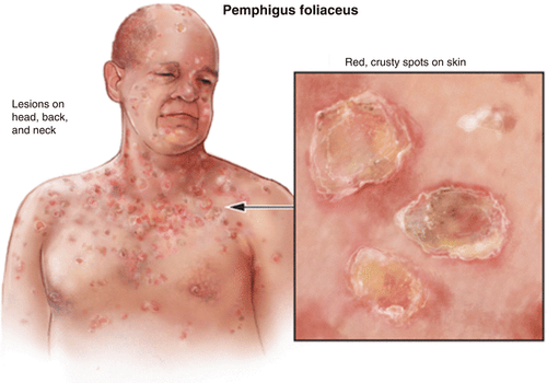 Bệnh lý Pemphigus foliaceus toàn thân