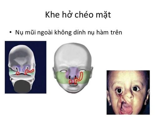 Hình ảnh nội soi khe hở mũi vòm miệng