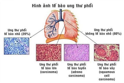 Ung thư biểu mô phổi