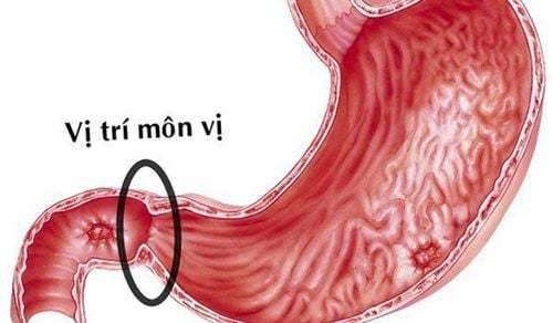 Hẹp phì đại môn vị ở trẻ