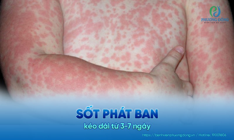 Hình ảnh trẻ bị sốt phát ban