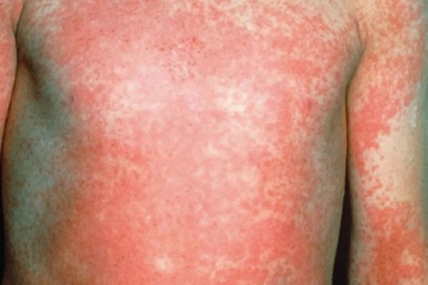 Dấu hiệu lưỡi dâu tây trong sốt tinh hồng nhiệt