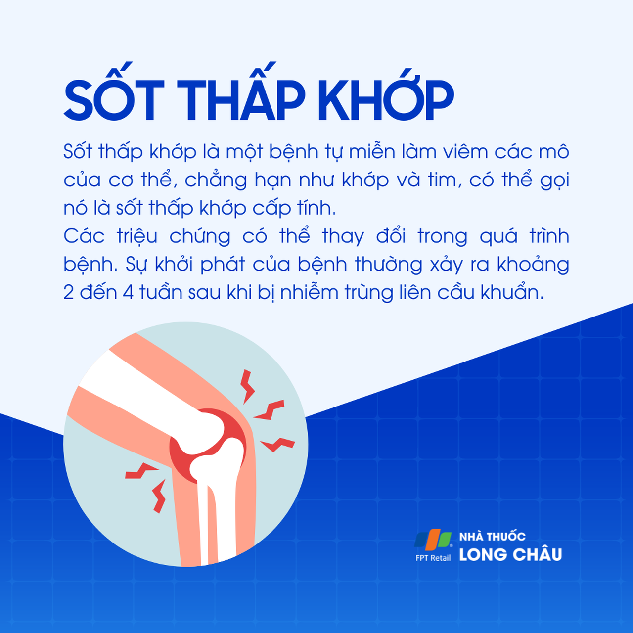 Hình ảnh minh họa bệnh sốt thấp khớp