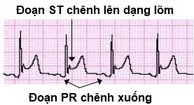 điện tâm đồ viêm màng ngoài tim