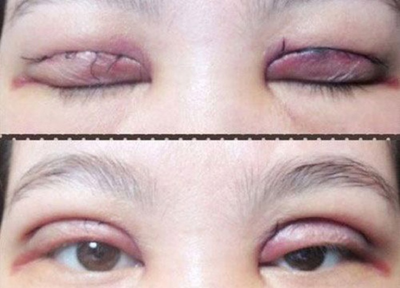 cắt mí bị lỗi