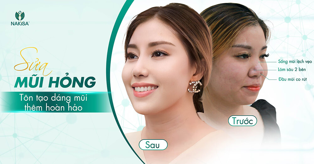 tái tạo sống mũi bị tụt
