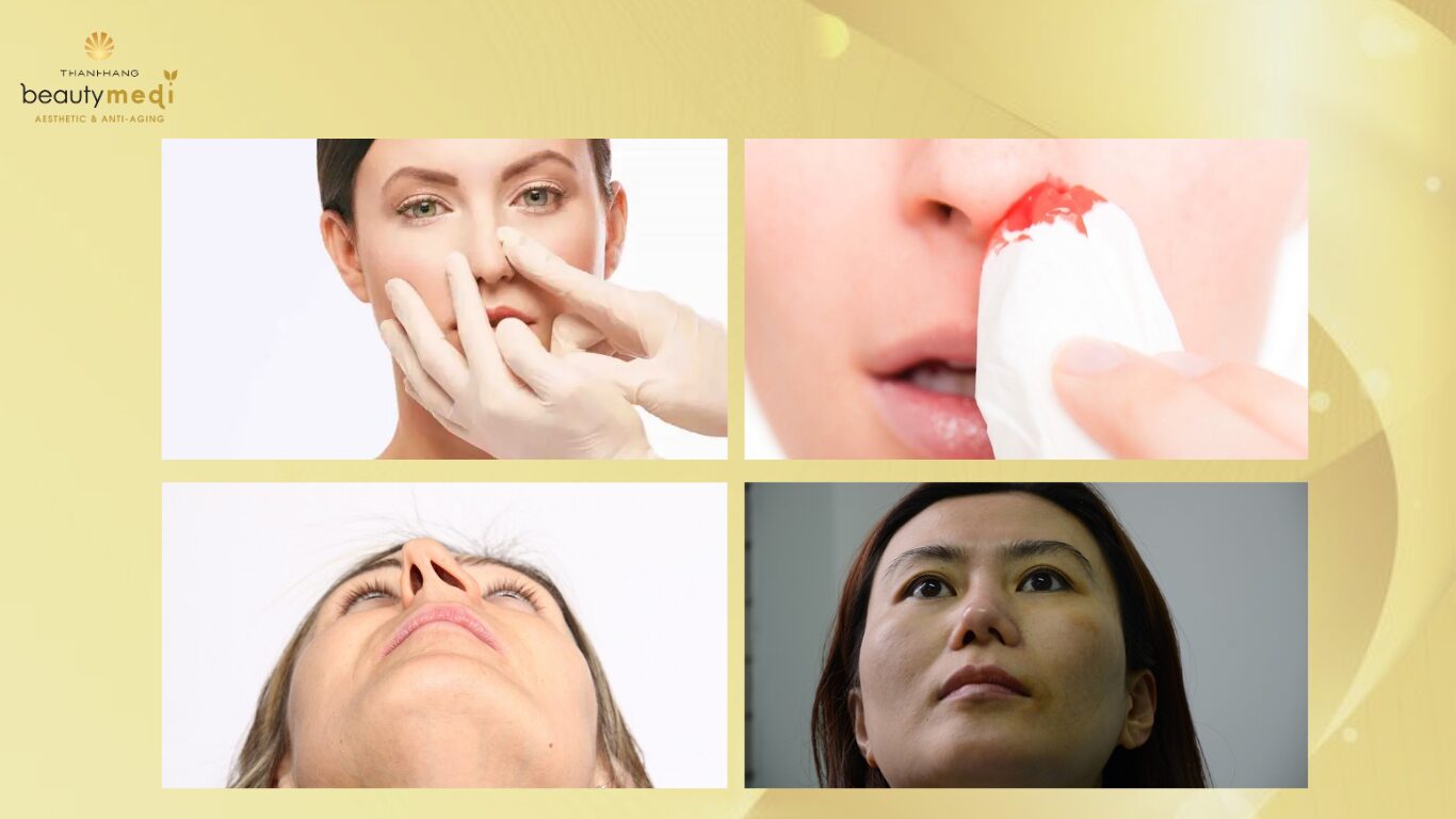 mũi bị hỏng sau nâng