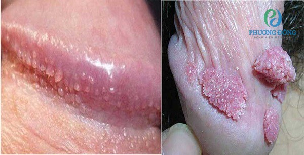 Điều trị sùi mào gà bằng ngoại khoa