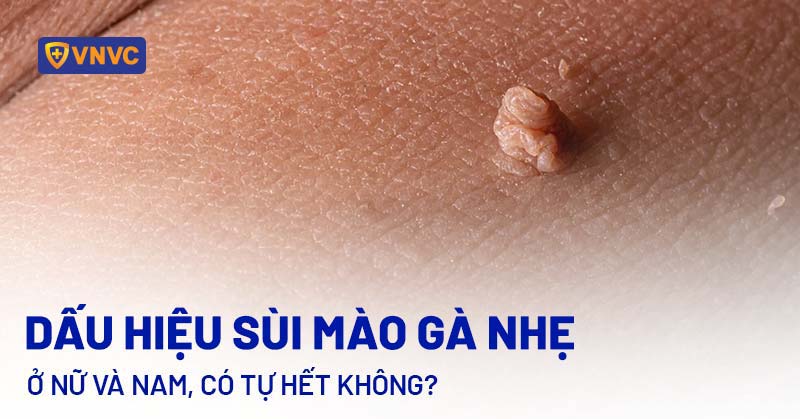 Sùi mào gà ở nữ