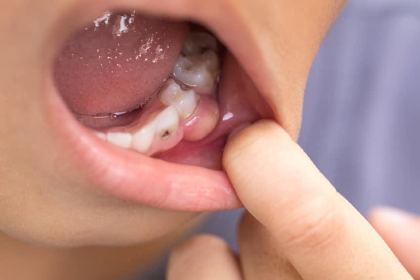 Hình ảnh nướu sưng viêm