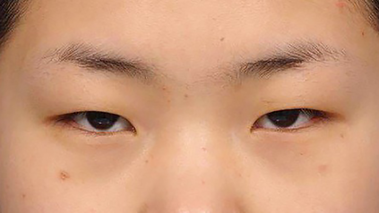 Sụp Mí Mắt: Nguyên Nhân, Triệu Chứng và Cách Điều Trị Từ A Đến Z 8 Trước và sau điều trị sụp mí mắt