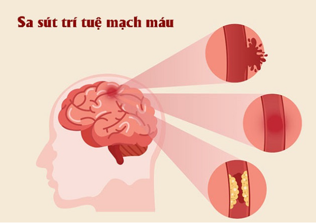 tổn thương não do sa sút trí tuệ mạch máu