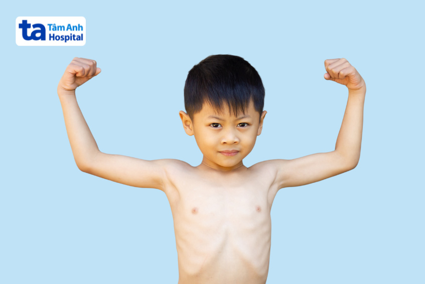 Trẻ bị suy dinh dưỡng thể gầy còm