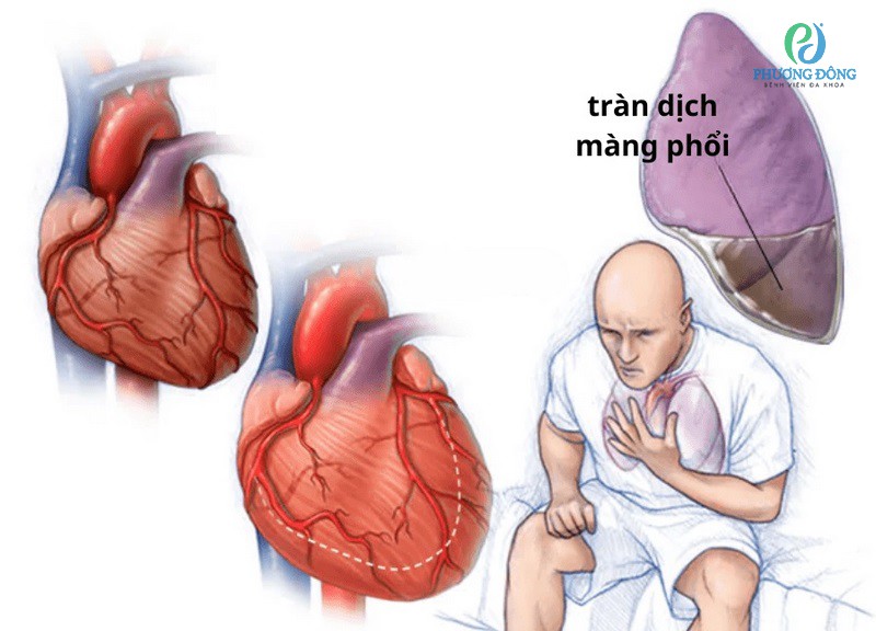 Suy tim gây tràn dịch màng phổi
