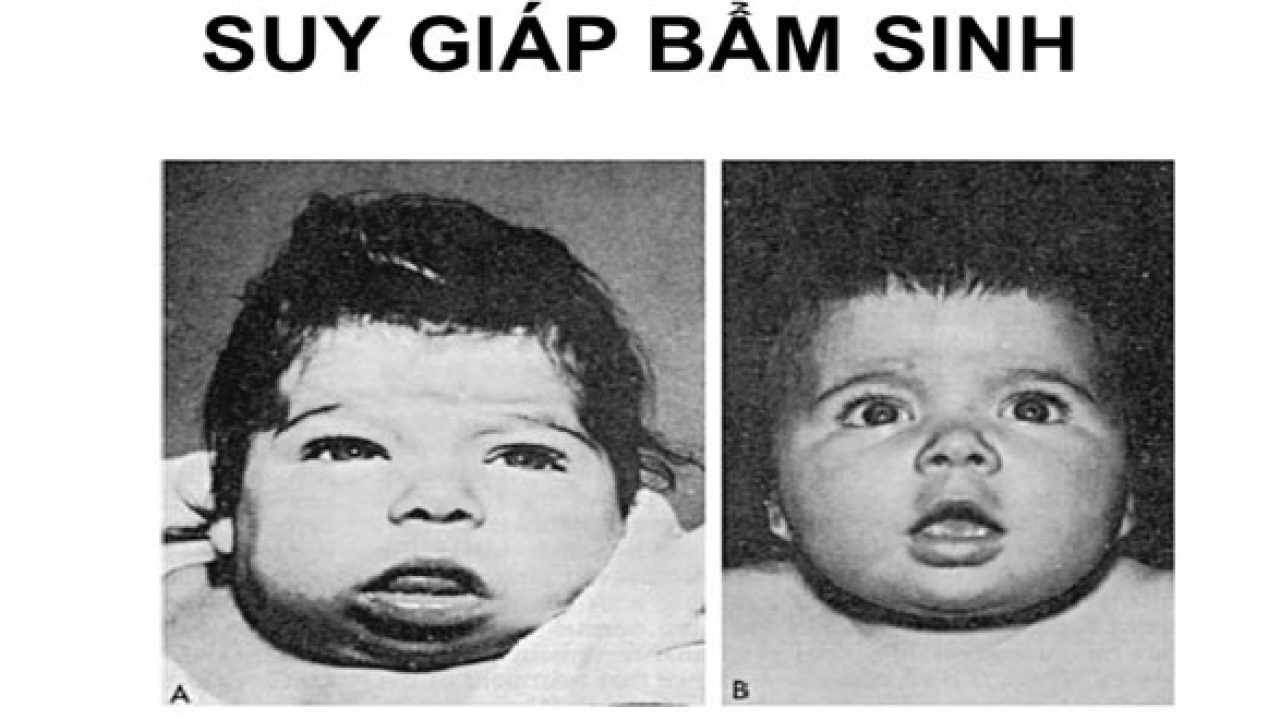 Triệu chứng suy giáp bẩm sinh