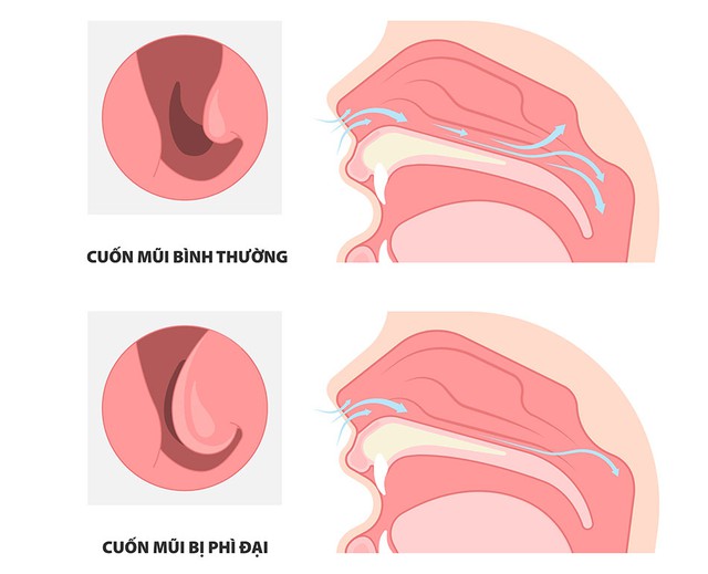 nghẹt mũi do xung huyết