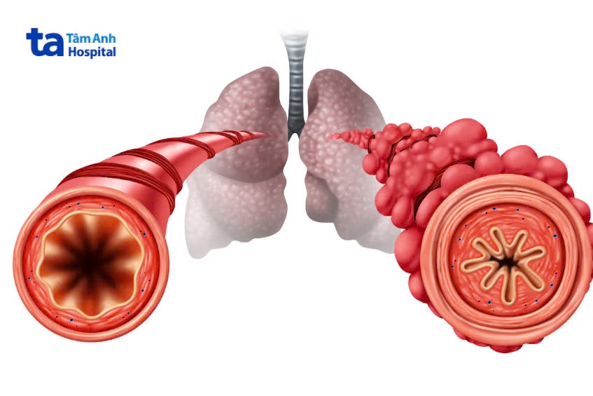 tắc nghẽn đường hô hấp dưới