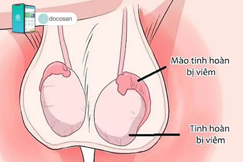 Chẩn đoán tắc ống dẫn tinh