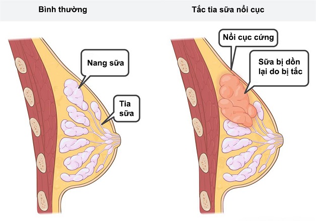 Tắc tia sữa