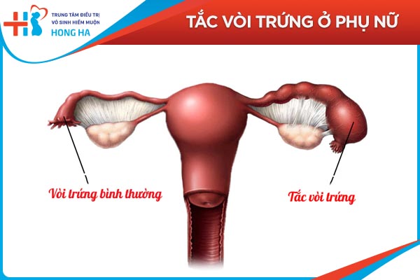 Tắc vòi trứng
