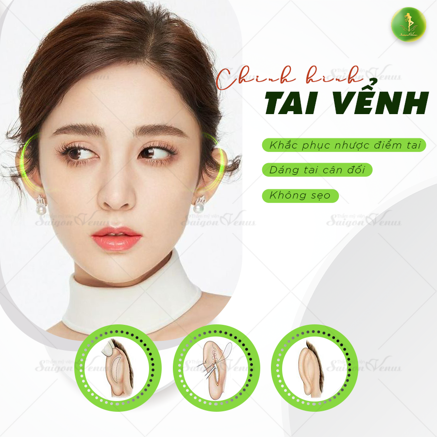 Hình ảnh trước và sau phẫu thuật tai vểnh
