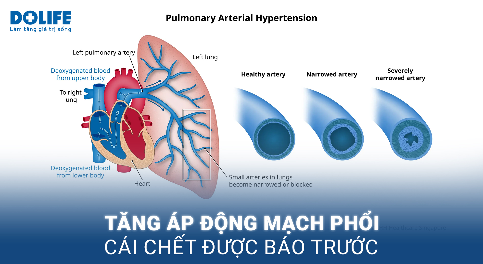 Hình minh họa tăng áp động mạch phổi