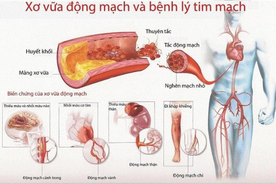 Tăng cholesterol gây xơ vữa động mạch
