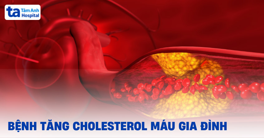Biến chứng viêm tụy do tăng chylomicron