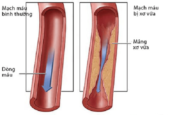Tăng cholesterol máu gia đình ở trẻ em