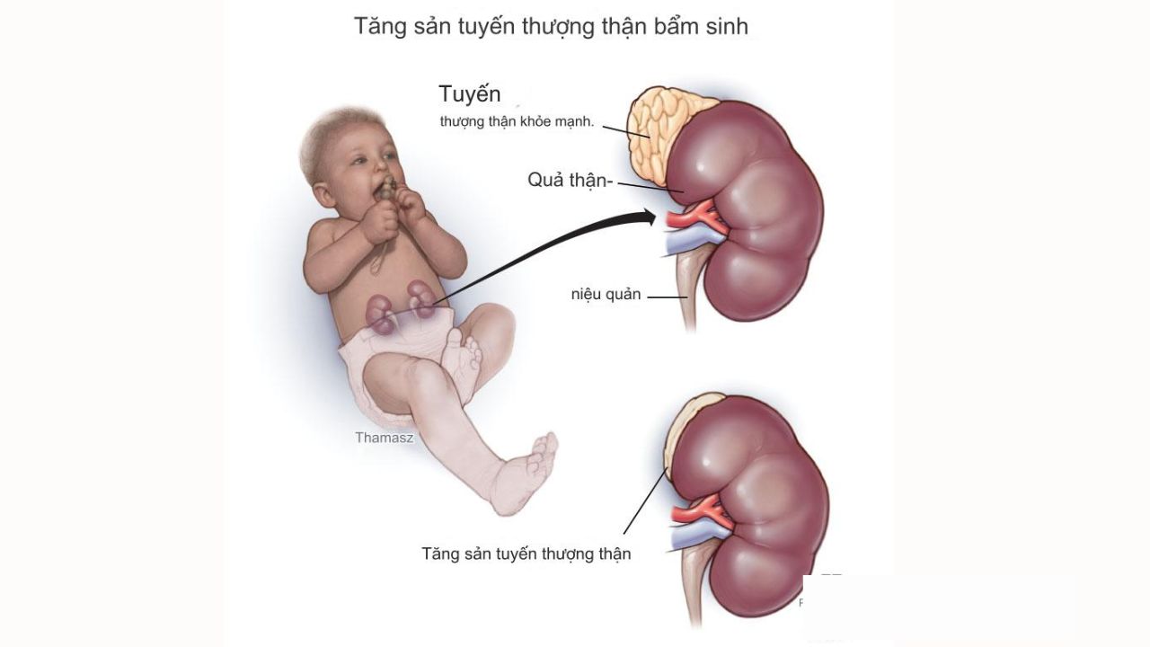 Tăng sản thượng thận bẩm sinh: Căn bệnh di truyền hiếm gặp cần được phát hiện sớm 3 Bé gái bị nam hóa cơ quan sinh dục ngoài