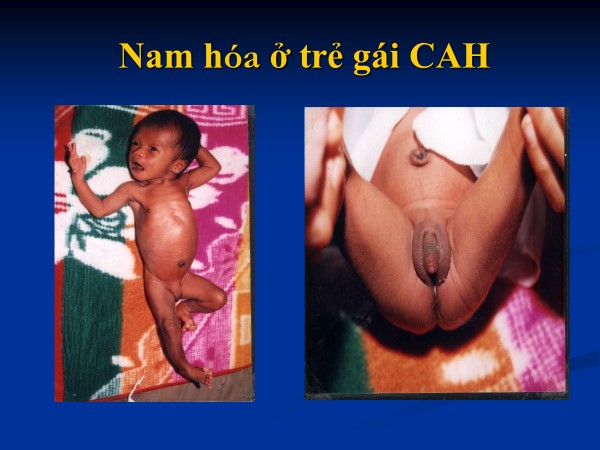 Tăng sản thượng thận bẩm sinh: Căn bệnh di truyền hiếm gặp cần được phát hiện sớm 4 Minh họa tuyến thượng thận trong cơ thể người
