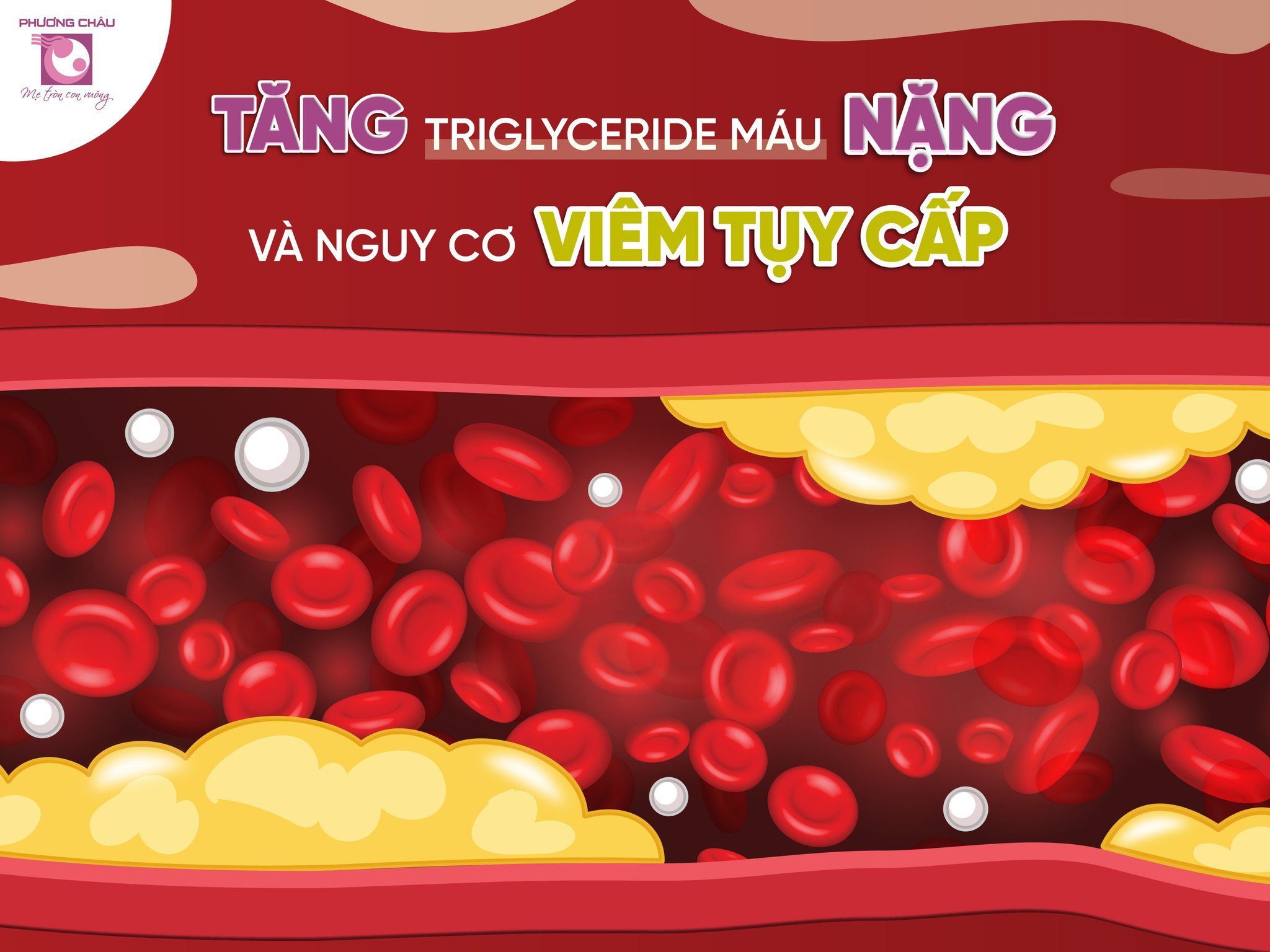 Biến chứng viêm tụy cấp do tăng triglyceride máu