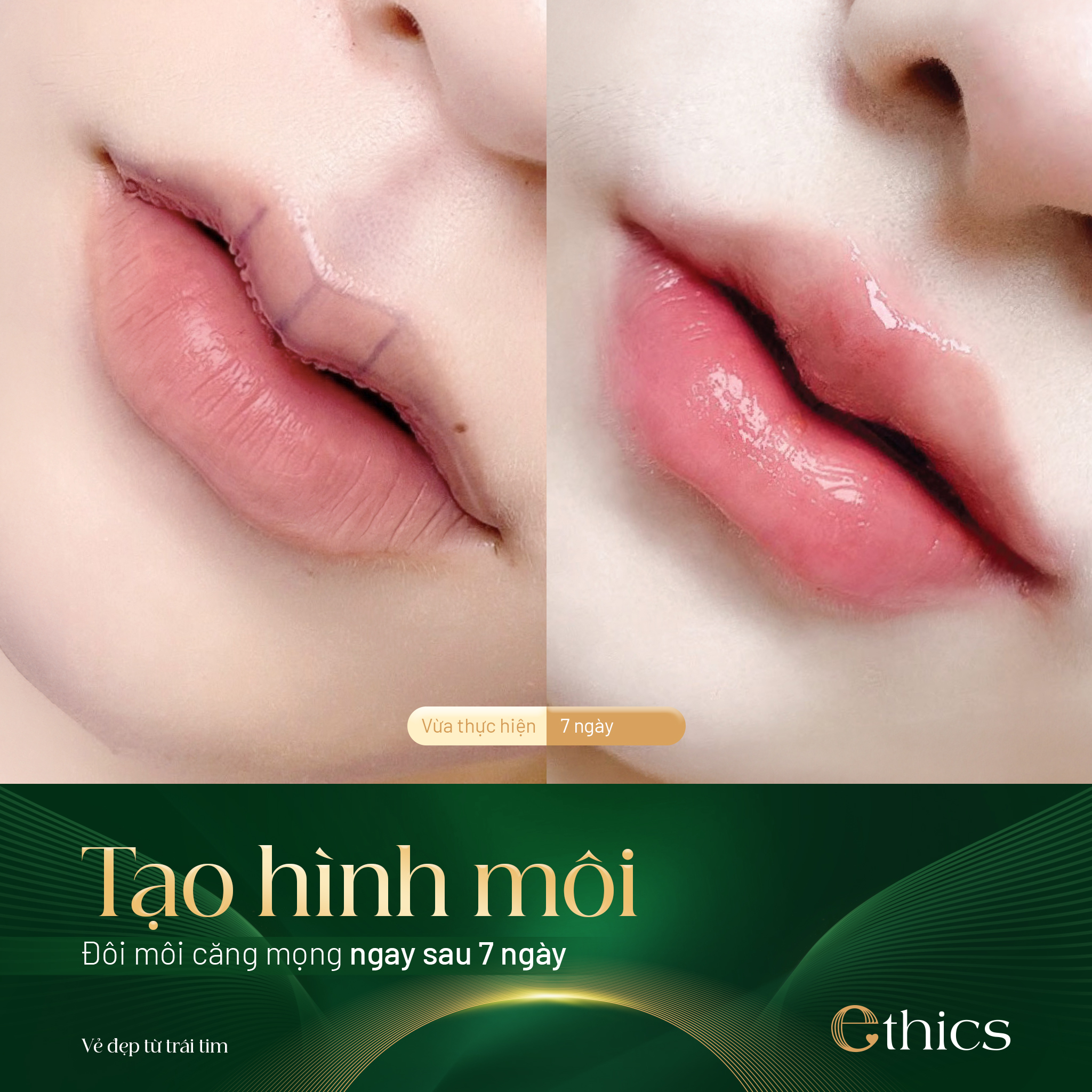 Tạo hình môi trái tim