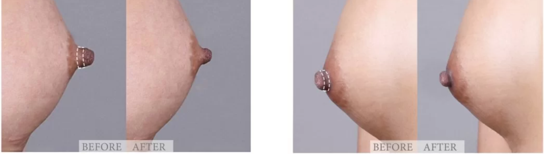 Trước và sau thu nhỏ quầng vú, đầu ti