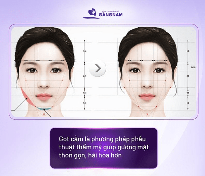 Quy trình gọt hàm V-line