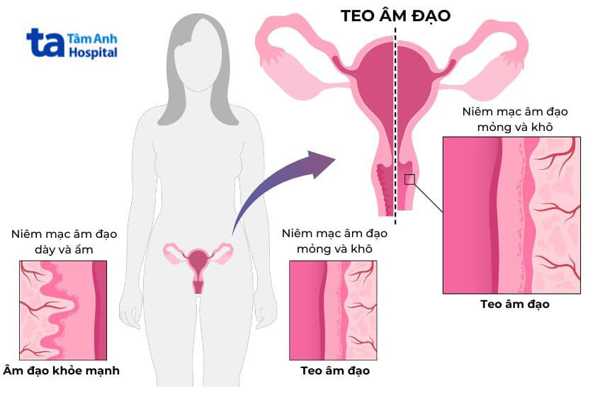 Teo âm đạo mãn kinh