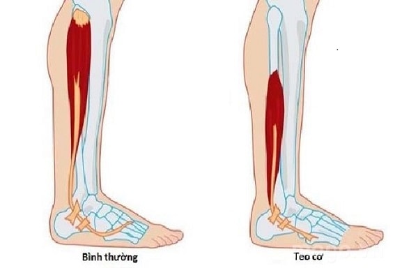 Teo cơ – biểu hiện điển hình của yếu cơ gốc chi
