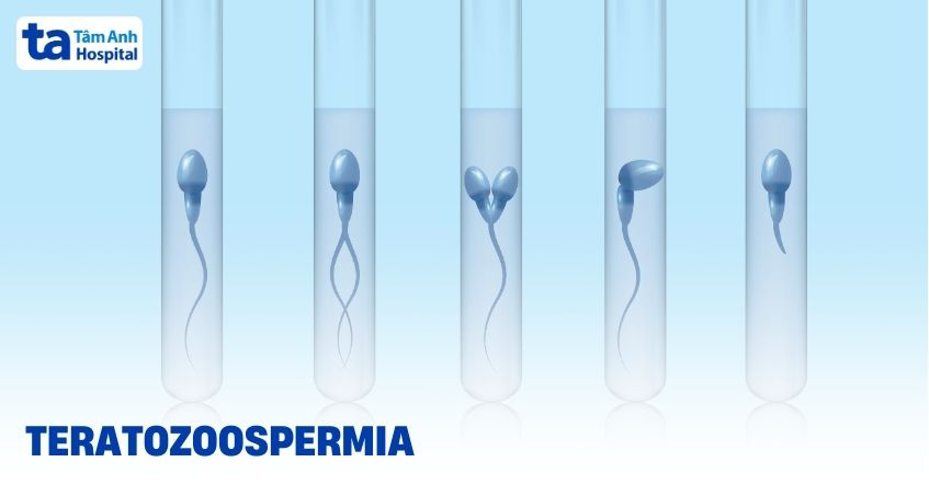 Teratozoospermia dưới kính hiển vi