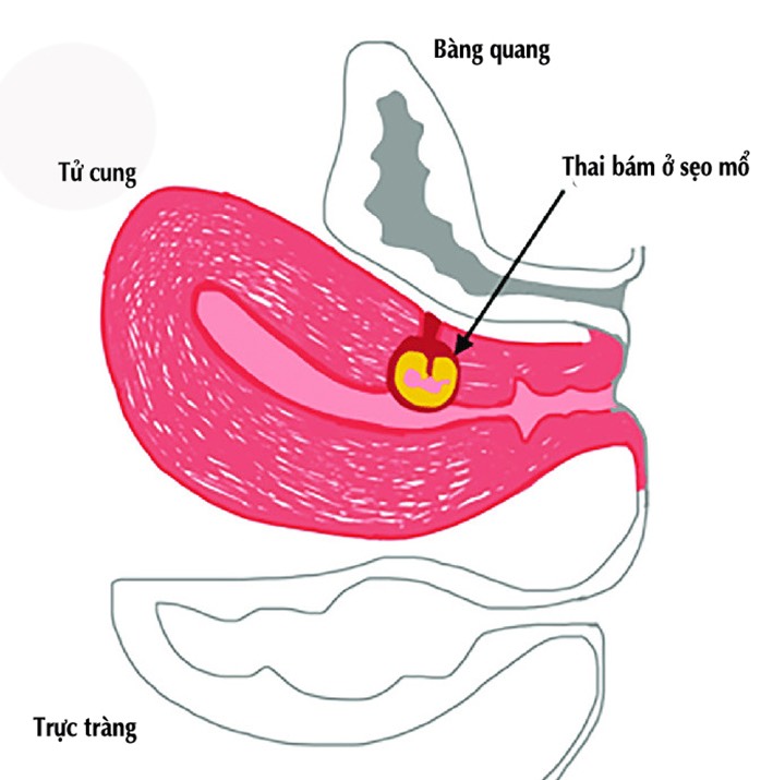 Điều trị thai trên sẹo mổ cũ