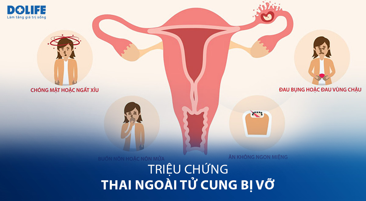 Vỡ túi thai ngoài tử cung thực tế