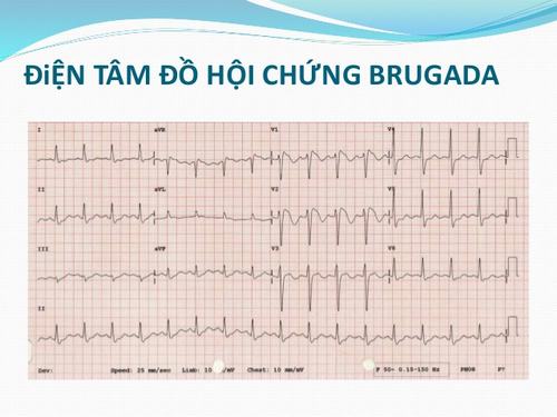 Gen SCN5A và hội chứng Brugada