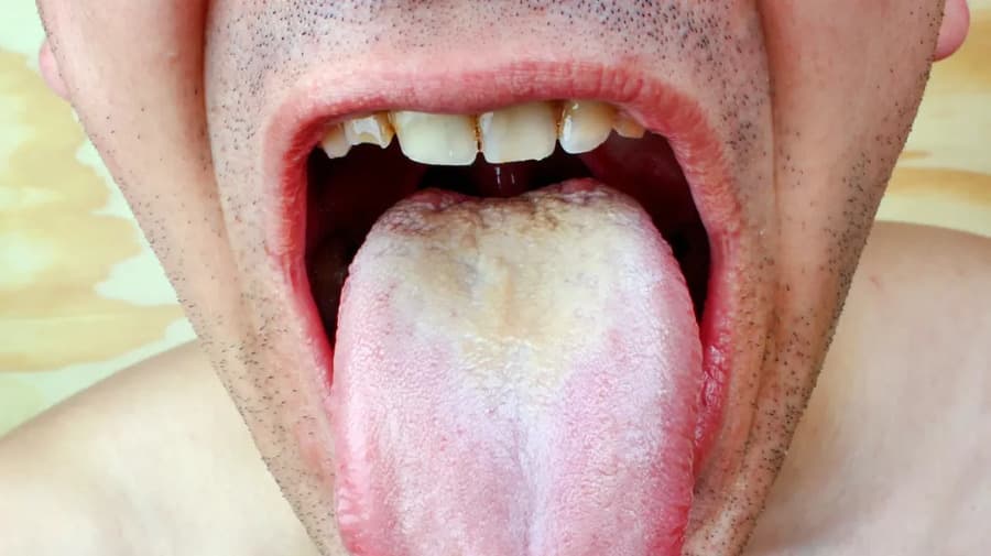 Lưỡi bẩn có bợn trắng