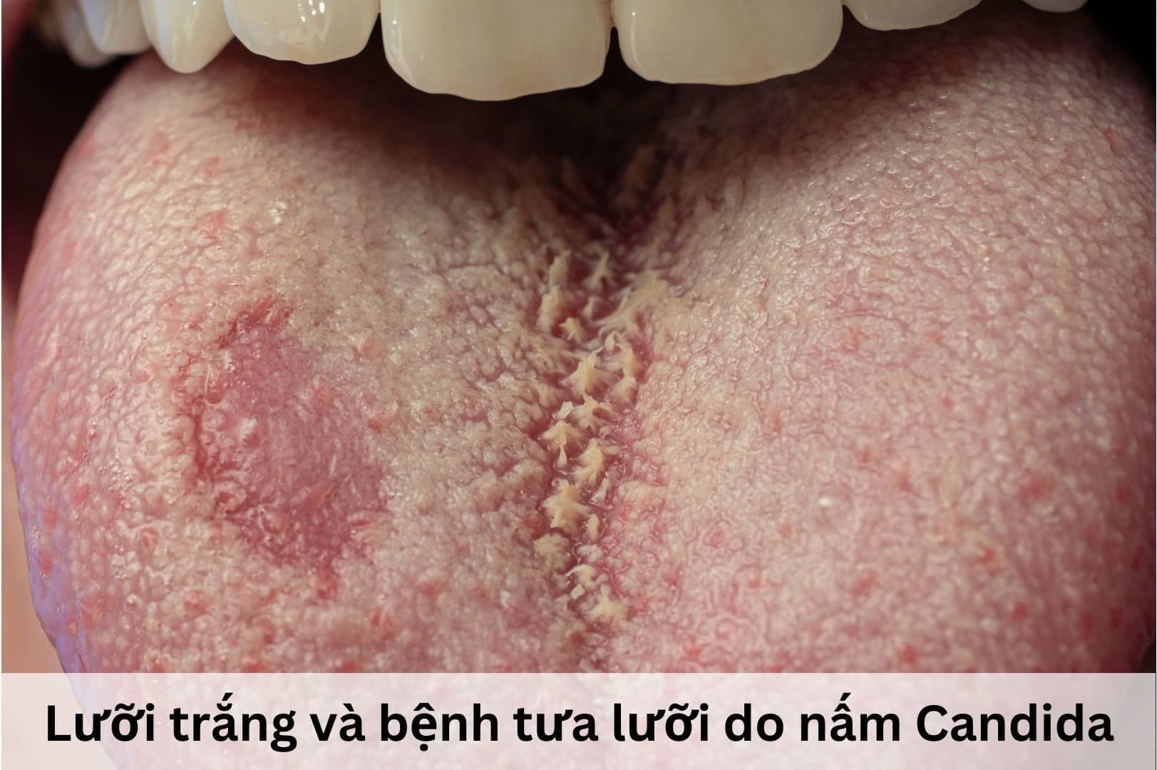 Nấm Candida trên lưỡi