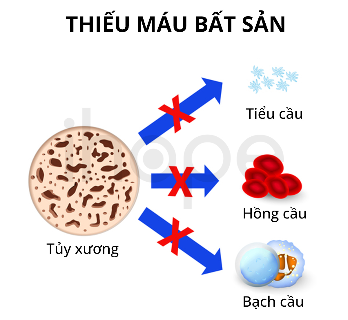 Thiếu Yếu Tố Đông Máu VII: Bệnh Lý Rối Loạn Chảy Máu Hiếm Gặp 8 chảy máu do thiếu yếu tố VII