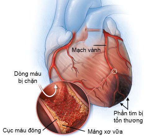 Tăng huyết áp (Cao huyết áp): Dấu hiệu nhận biết, nguyên nhân, điều trị và cách phòng ngừa 8 Triệu chứng tăng huyết áp