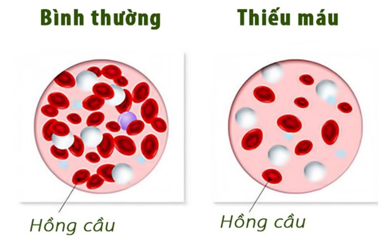 Thiếu máu do bệnh mạn tính